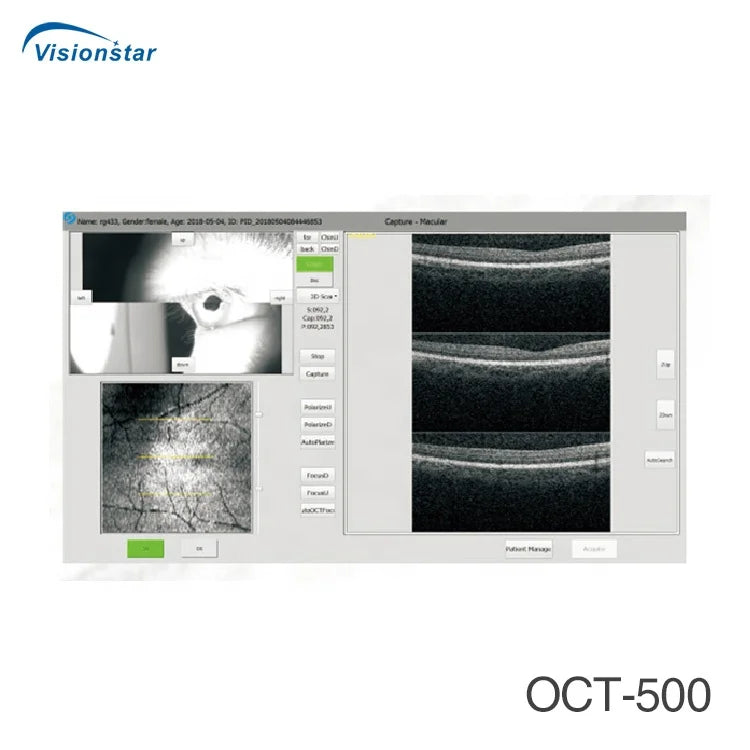 Optical Coherence Tomography Ophthalmology OCT Machine for Eye Exam I ...